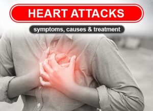 Heart Attacks: Symptoms, Causes, Treatment 