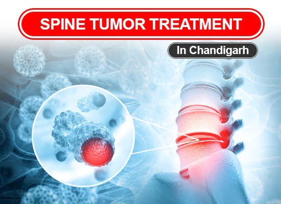 Spine Tumor Treatment