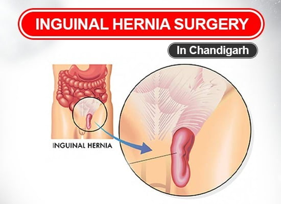 Inguinal Hernia Surgery in Chandigarh