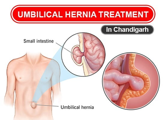 Umbilical Hernia Treatment