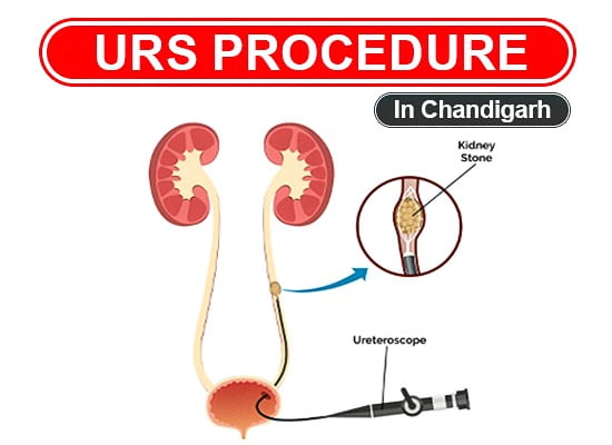 Ureteroscopy for Kidney Stone